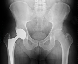 depuy hip recall