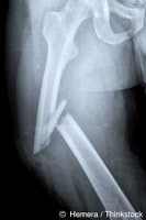 fractured-thigh-fosamax
